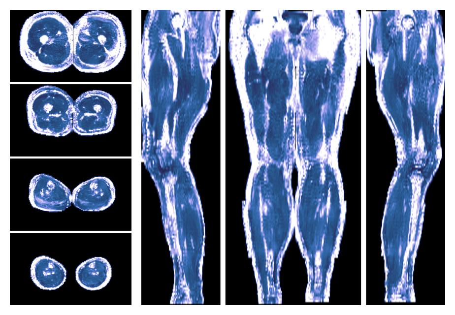 IVIM corrected whole leg muscle fractional anisotropy obtained from diffusion tensor imaging.
